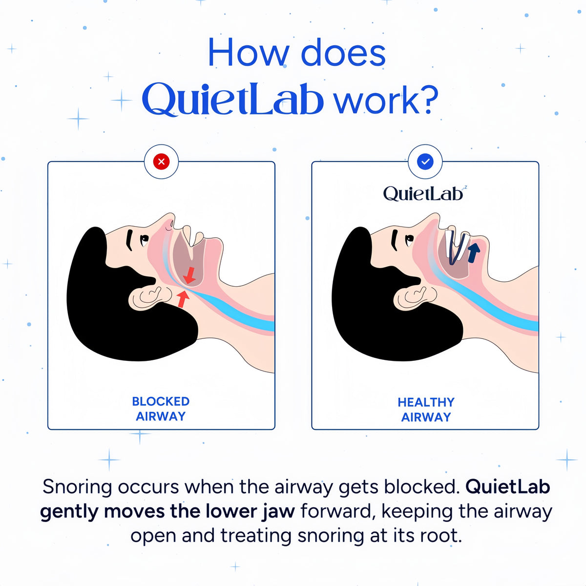 QUIETLAB® Mouth Guard for Sleeping - Anti-Snoring Device, Custom Fit