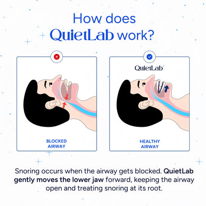 QUIETLAB® Mouth Guard for Sleeping - Anti-Snoring Device, Custom Fit